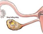 Các loại u nang buồng trứng