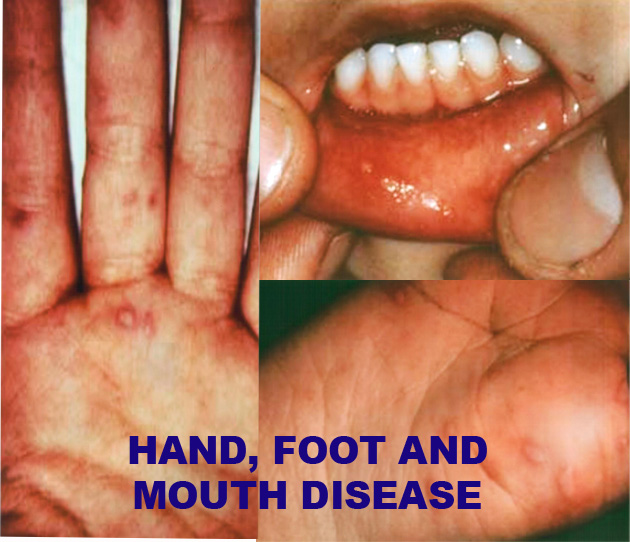 Tay chân miệng, nguyên nhân và con đường lây nhiễm